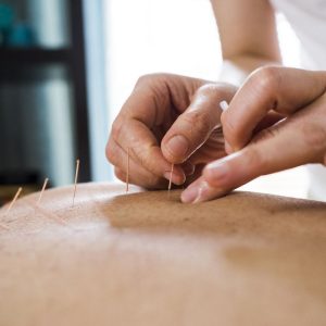 Photo of woman having acupuncture treatment. Alternative Medicine.